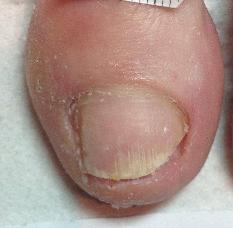 Signs You Have A Fungal Nail Infection And How To Stop It